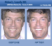 Smile Before and After