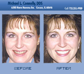 Smile Before and After