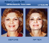 Smile Before and After