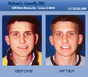 Smile Before and After