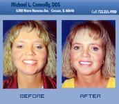 Smile Before and After