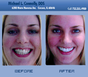 Smile Before and After