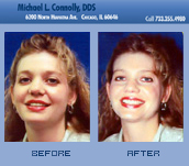 Smile Before and After