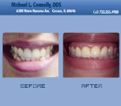 Smile Before and After