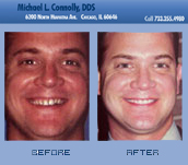 Smile Before and After