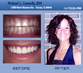 Smile Before and After